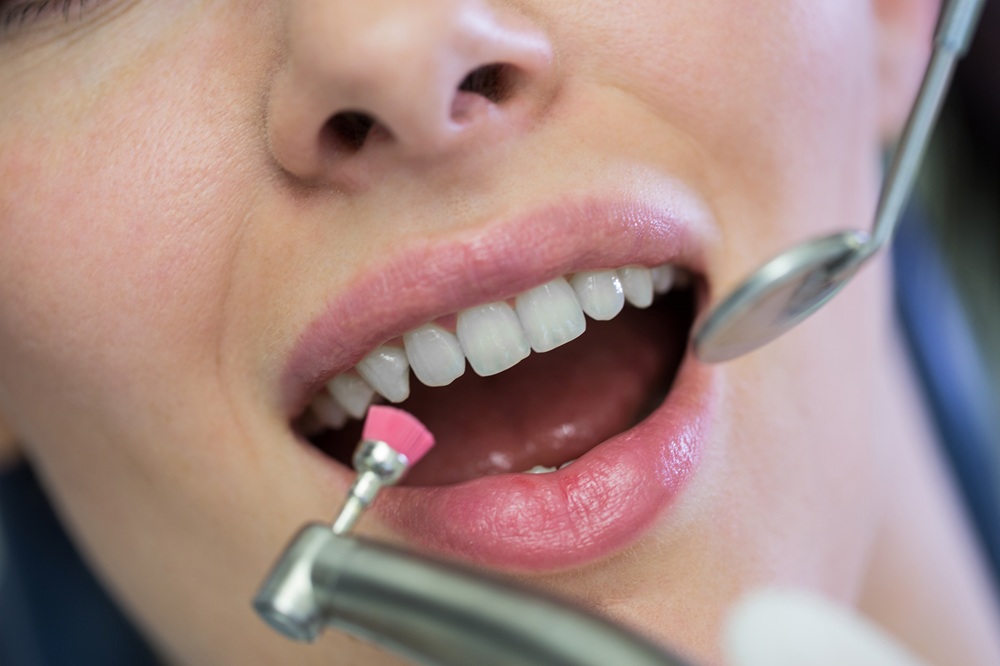 Is Dental Cleaning Painful? What to Expect